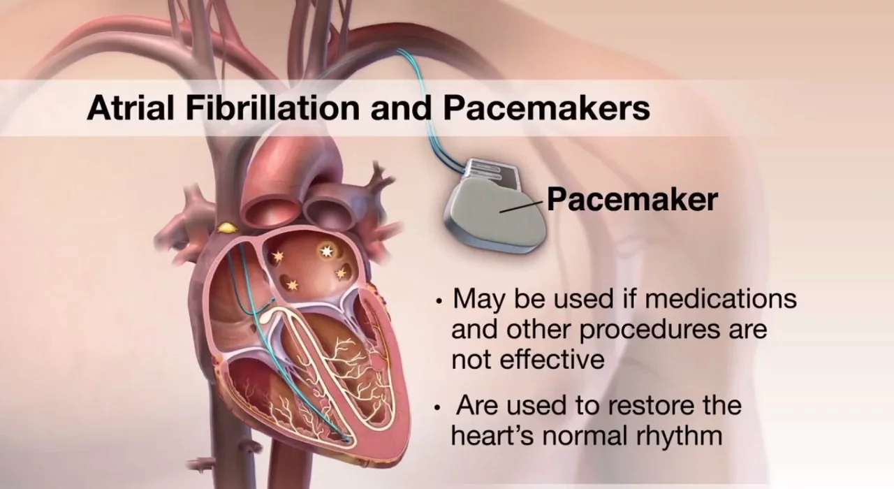 Amiodarone and the Treatment of Atrial Flutter: A Comprehensive Guide