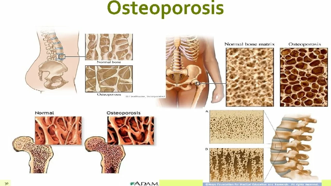 Living with Osteoporosis: Tips for Maintaining a Healthy Lifestyle